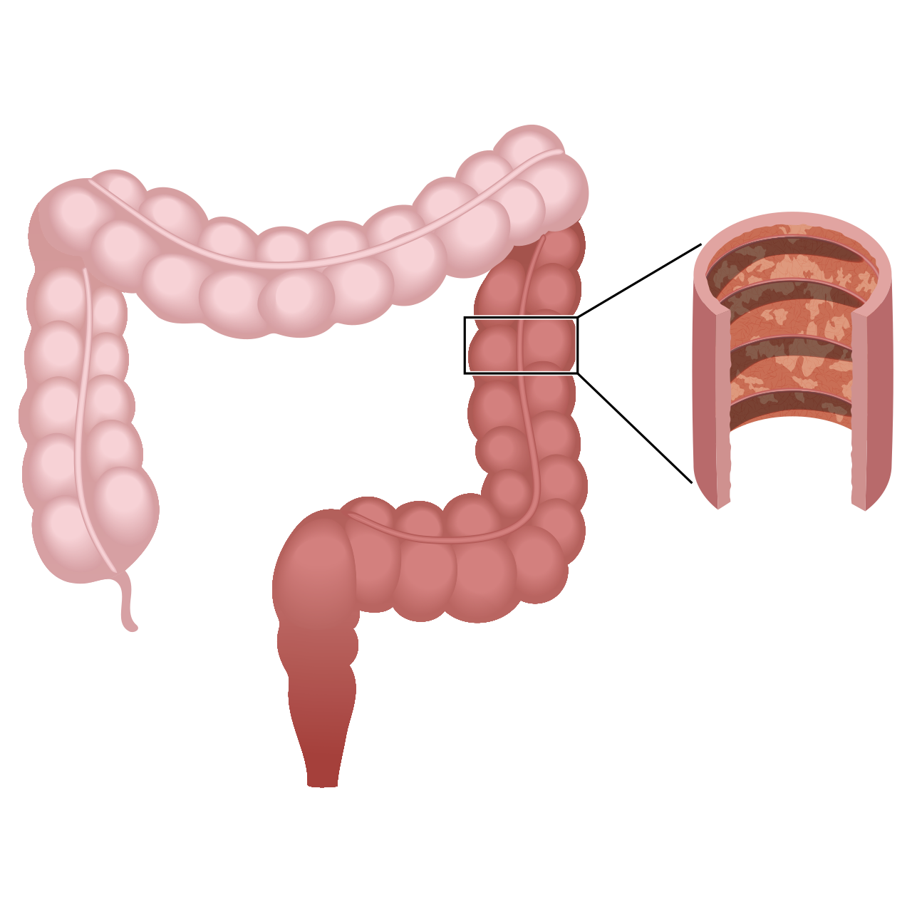 Colitis