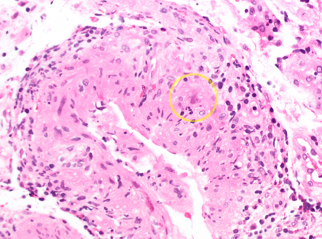 Colitis