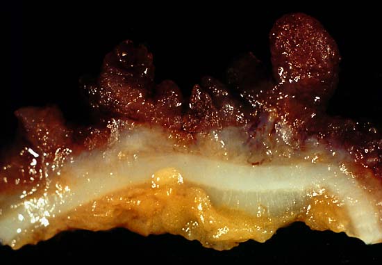 Colitis