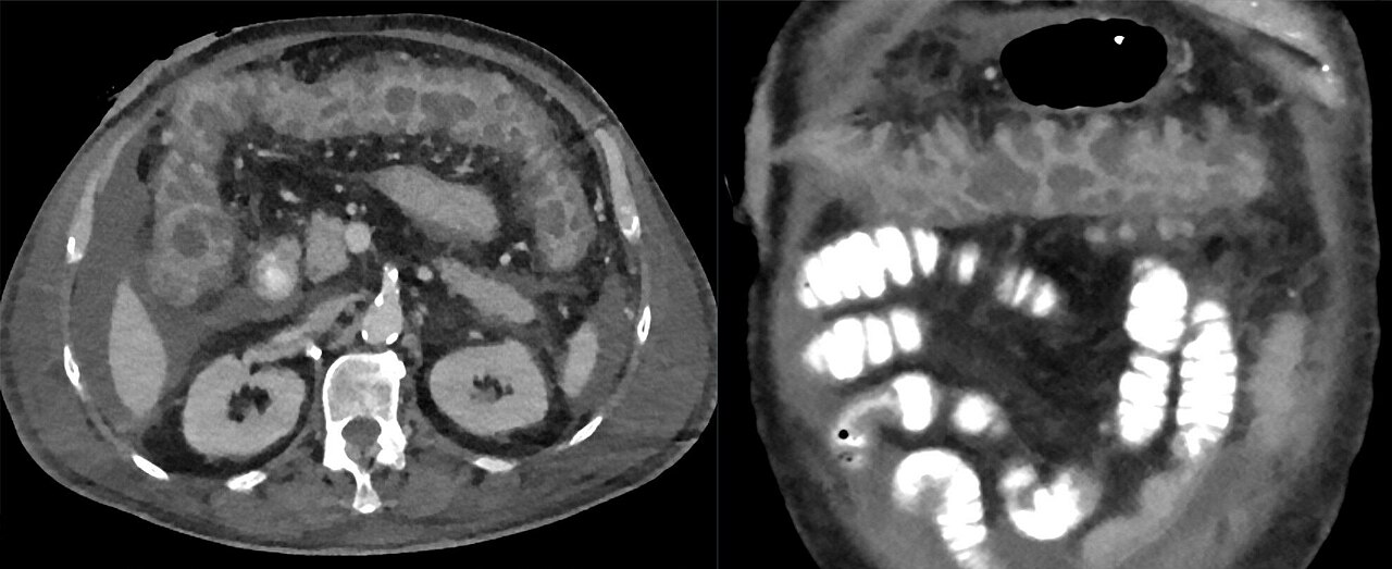 Colitis