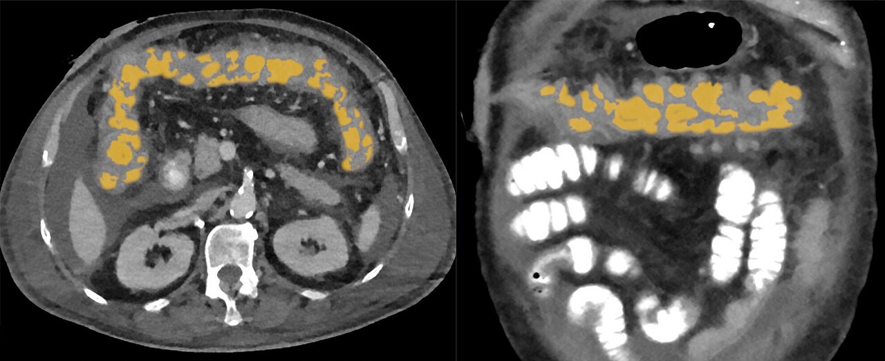 Colitis