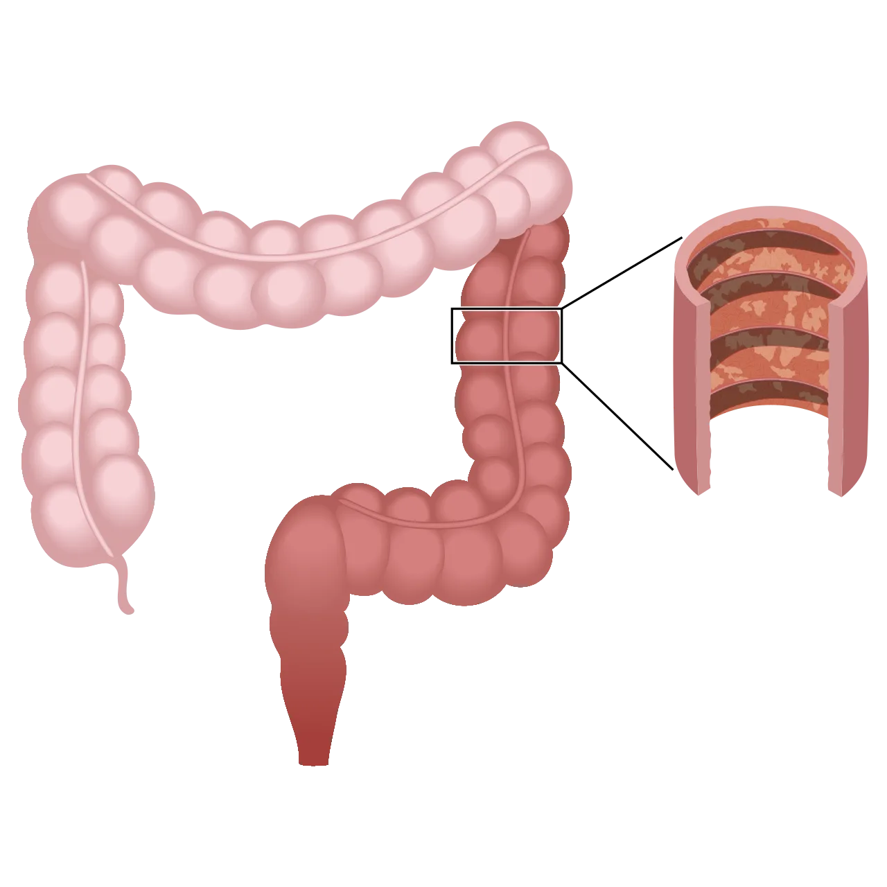Colitis