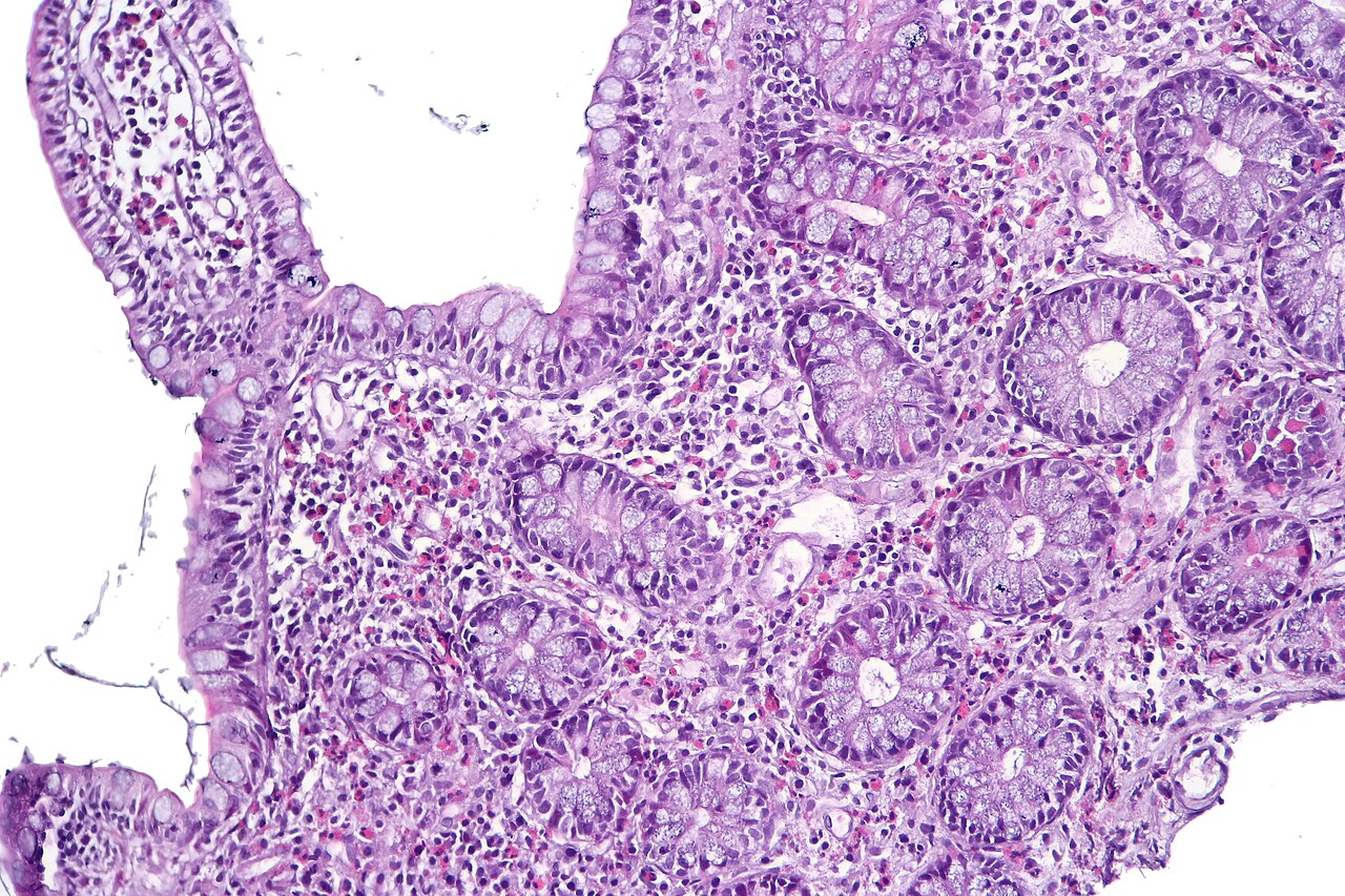 Enteritis