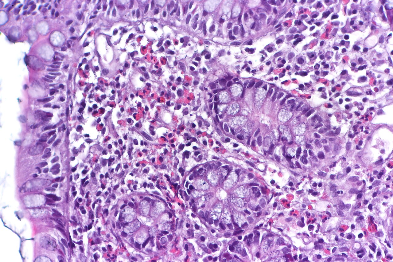 Enteritis