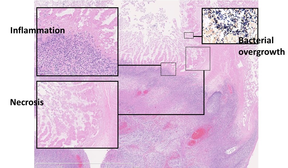 Enterocolitis