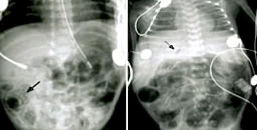 Enterocolitis