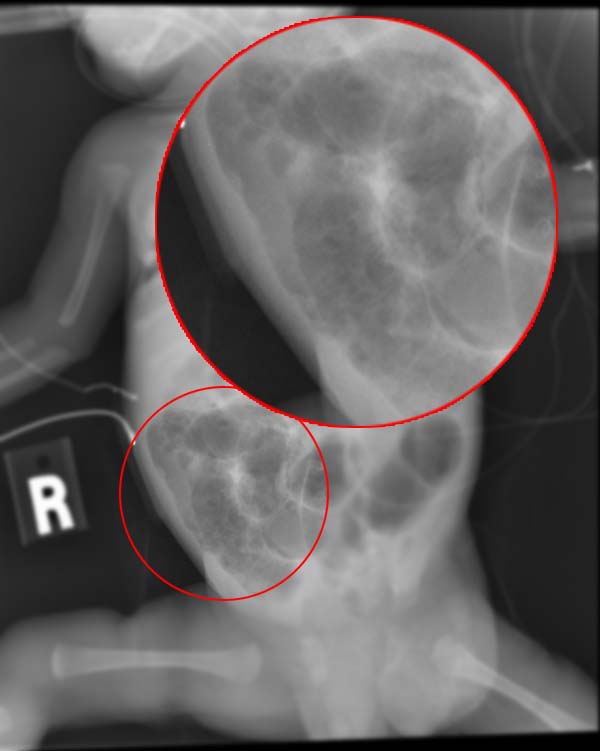 Enterocolitis