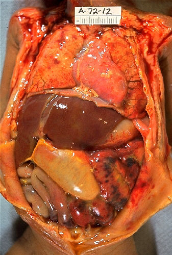 Enterocolitis