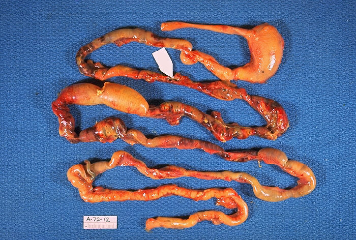 Enterocolitis