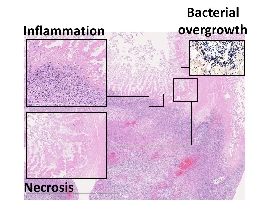 Enterocolitis