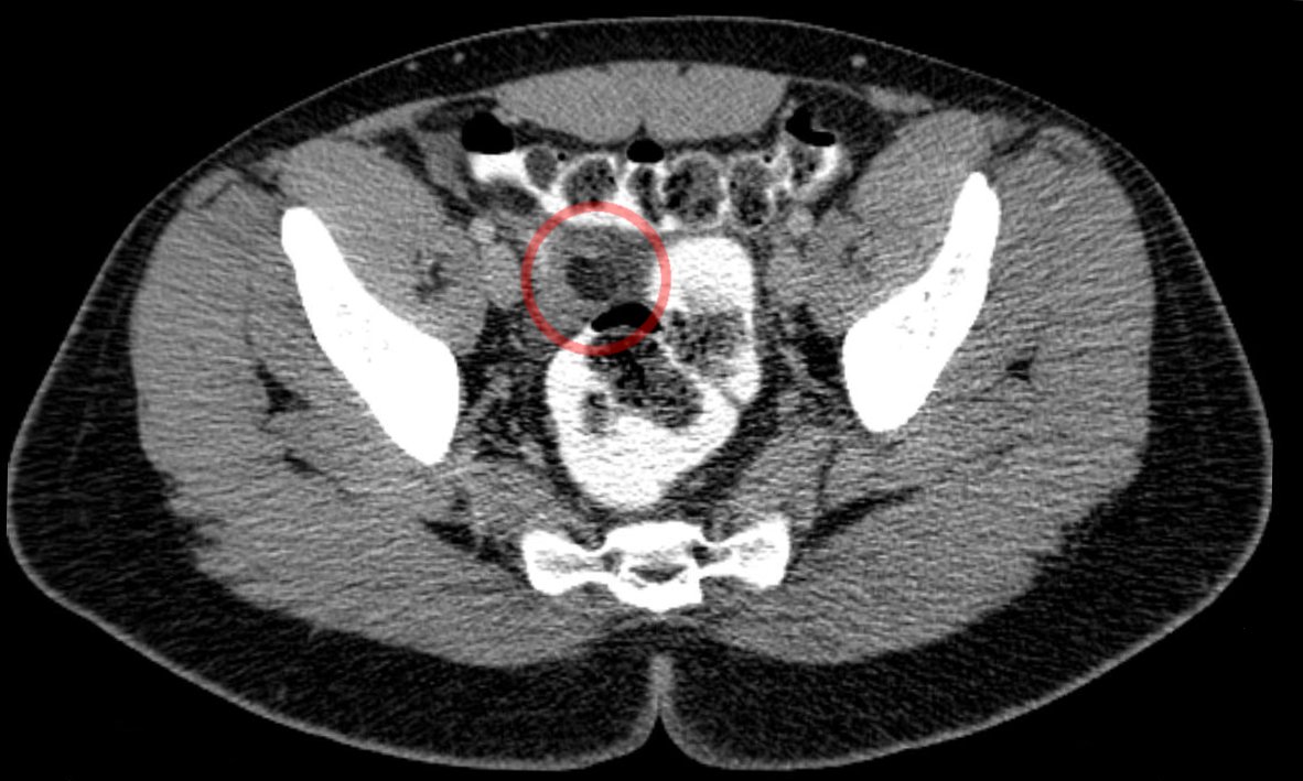 Epiploic appendagitis