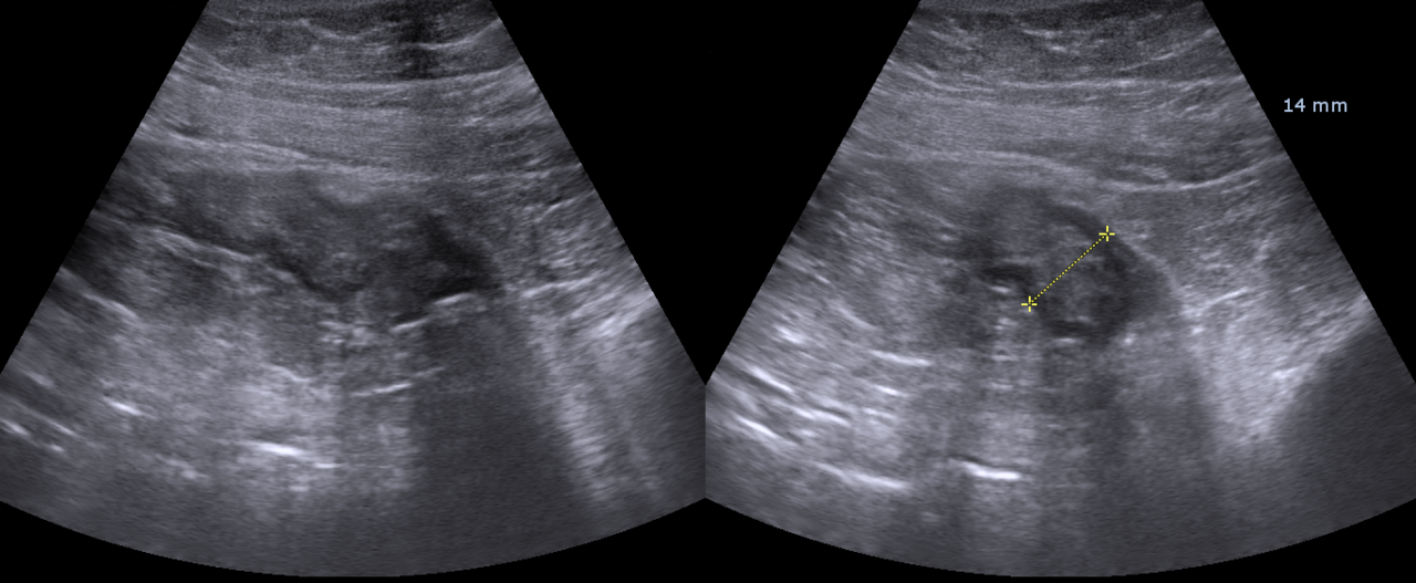 Epiploic appendagitis