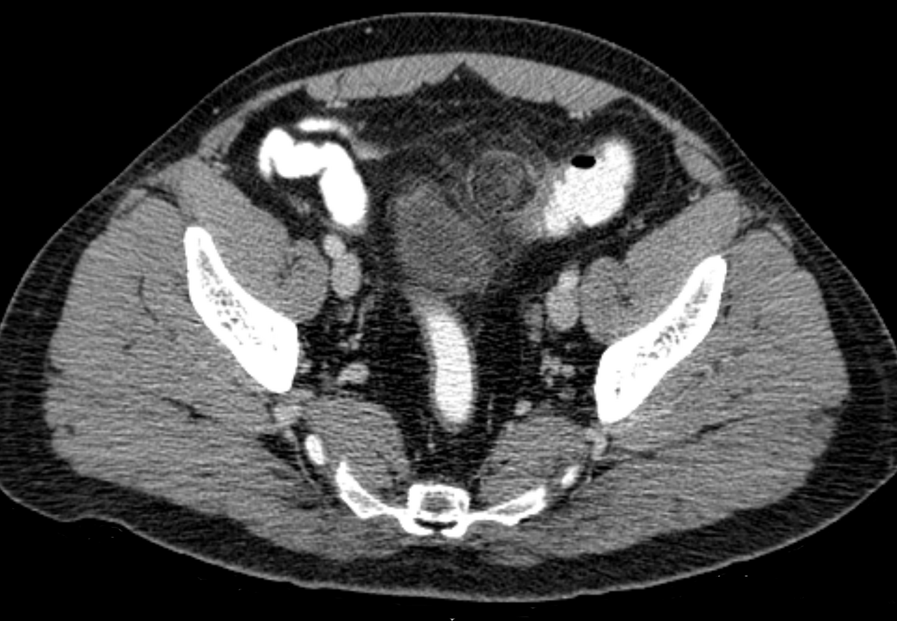 Epiploic appendagitis