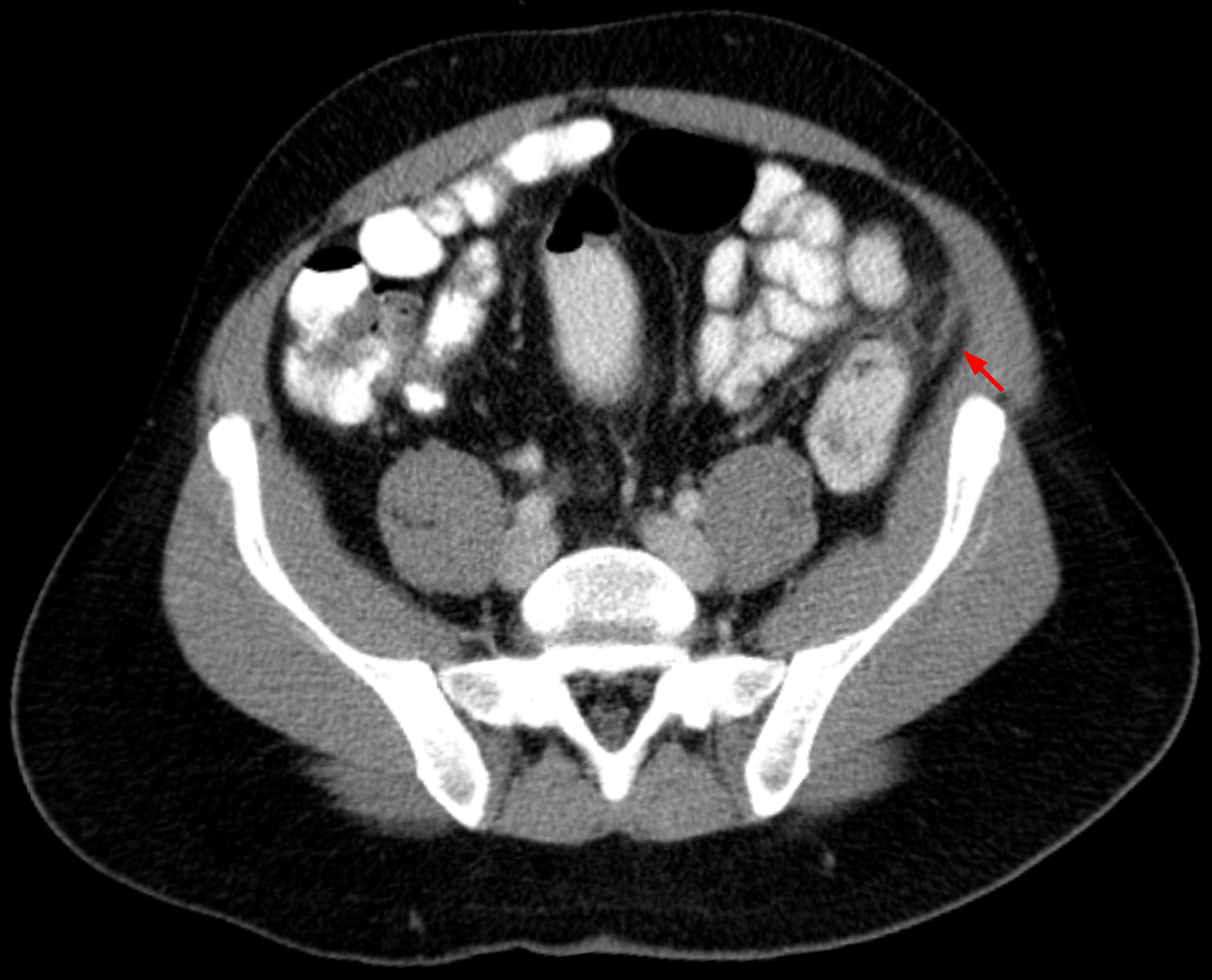 Epiploic appendagitis