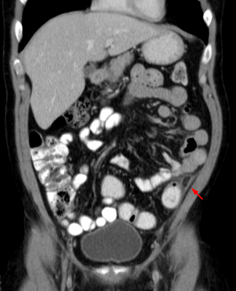 Epiploic appendagitis