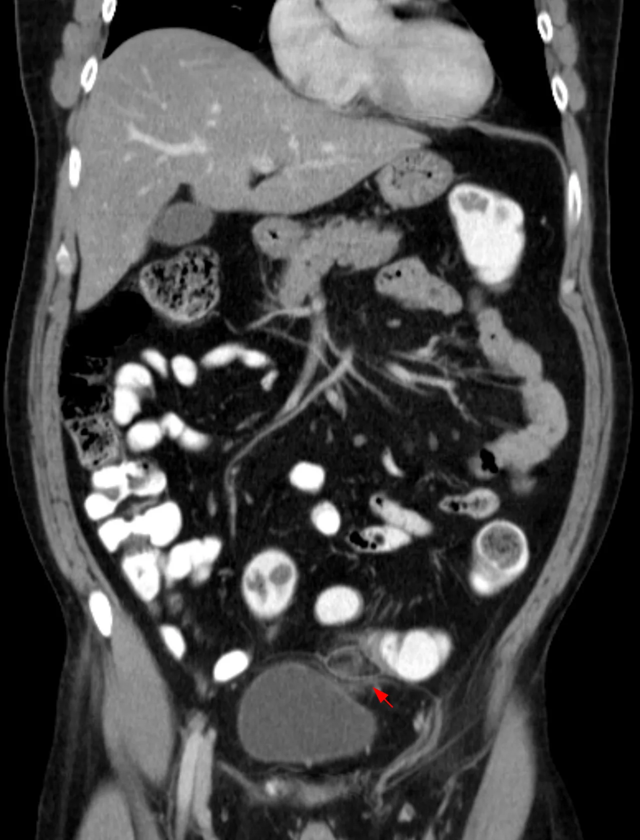 Epiploic appendagitis