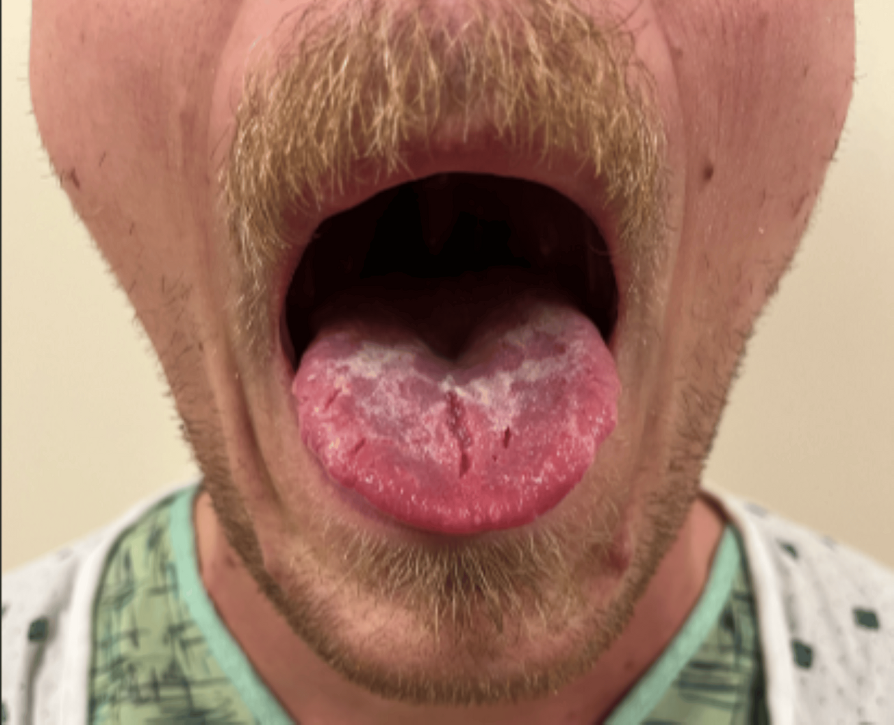 Esophagitis