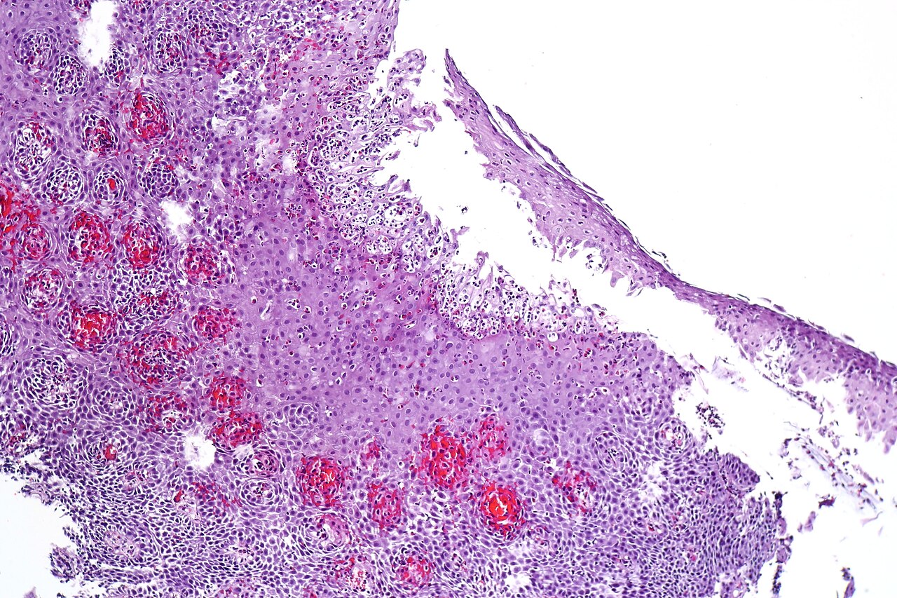 Esophagitis