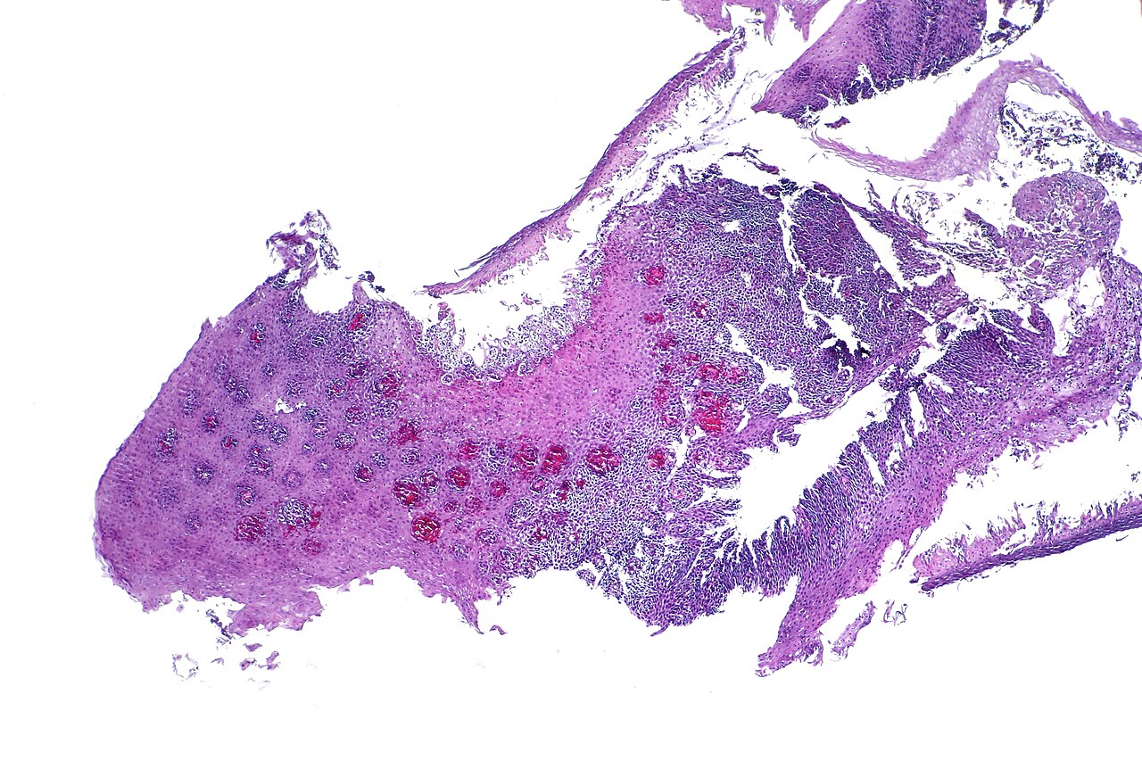 Esophagitis