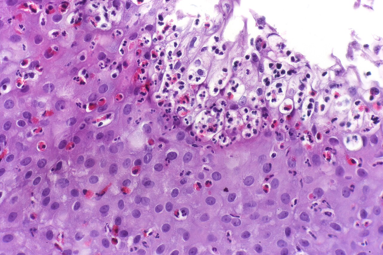 Esophagitis