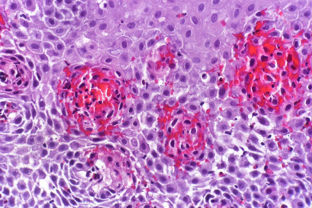Esophagitis