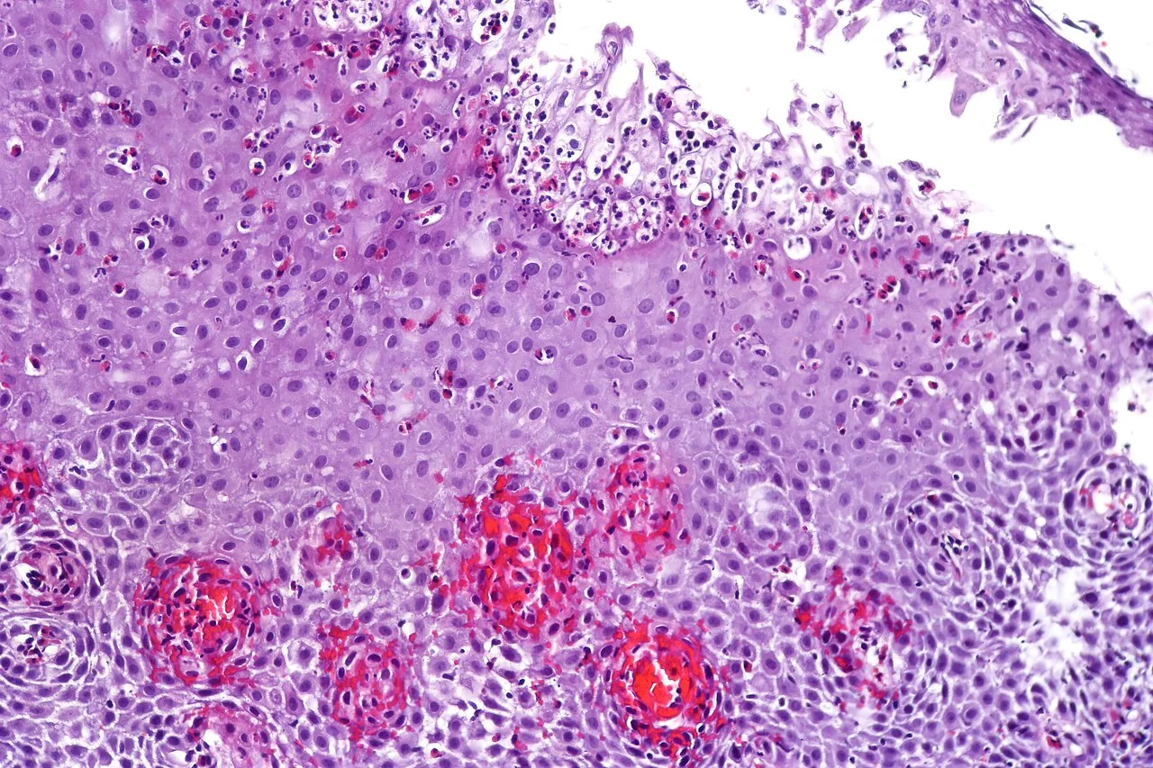 Esophagitis