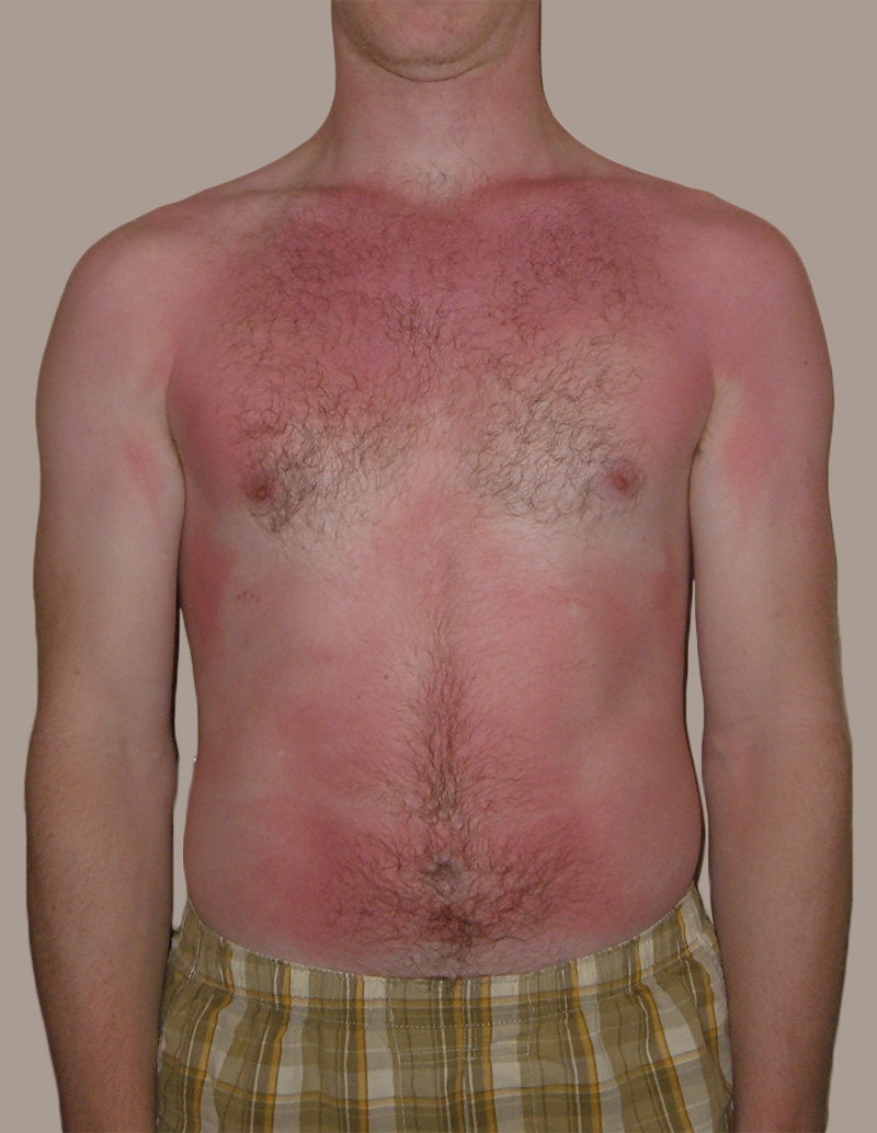 Sunburn