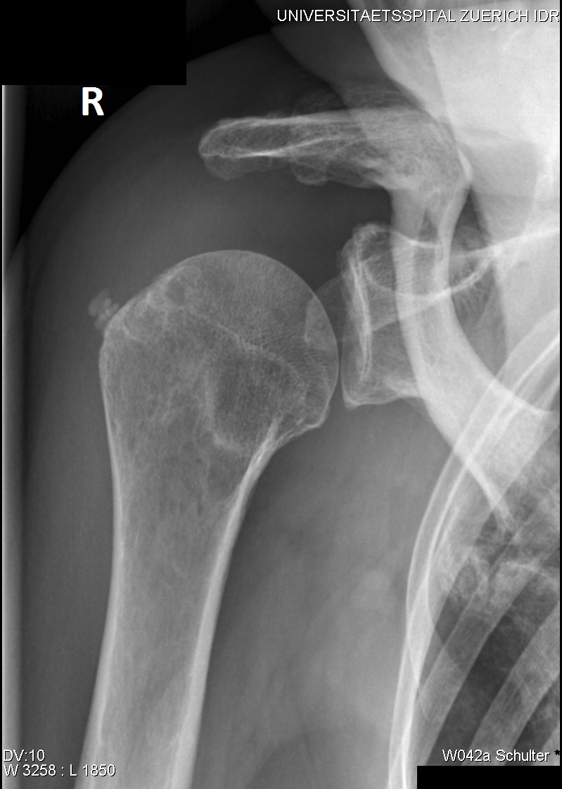 Tendinopathy