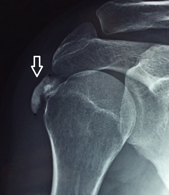 Tendinopathy