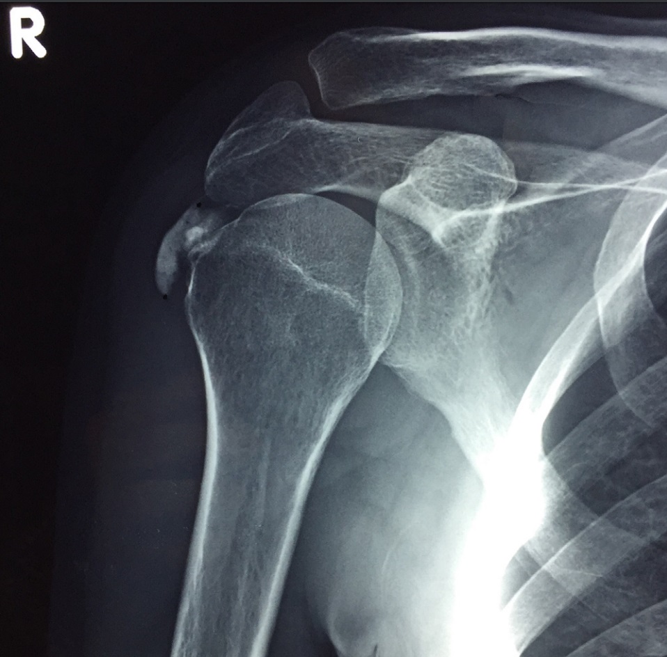 Tendinopathy