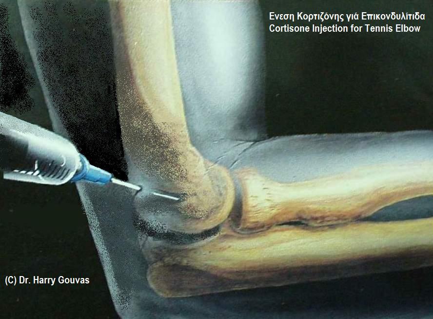 Tennis elbow