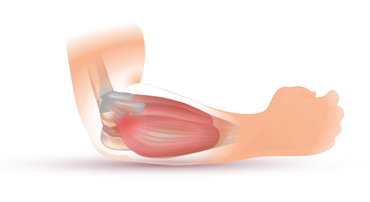 Tennis elbow