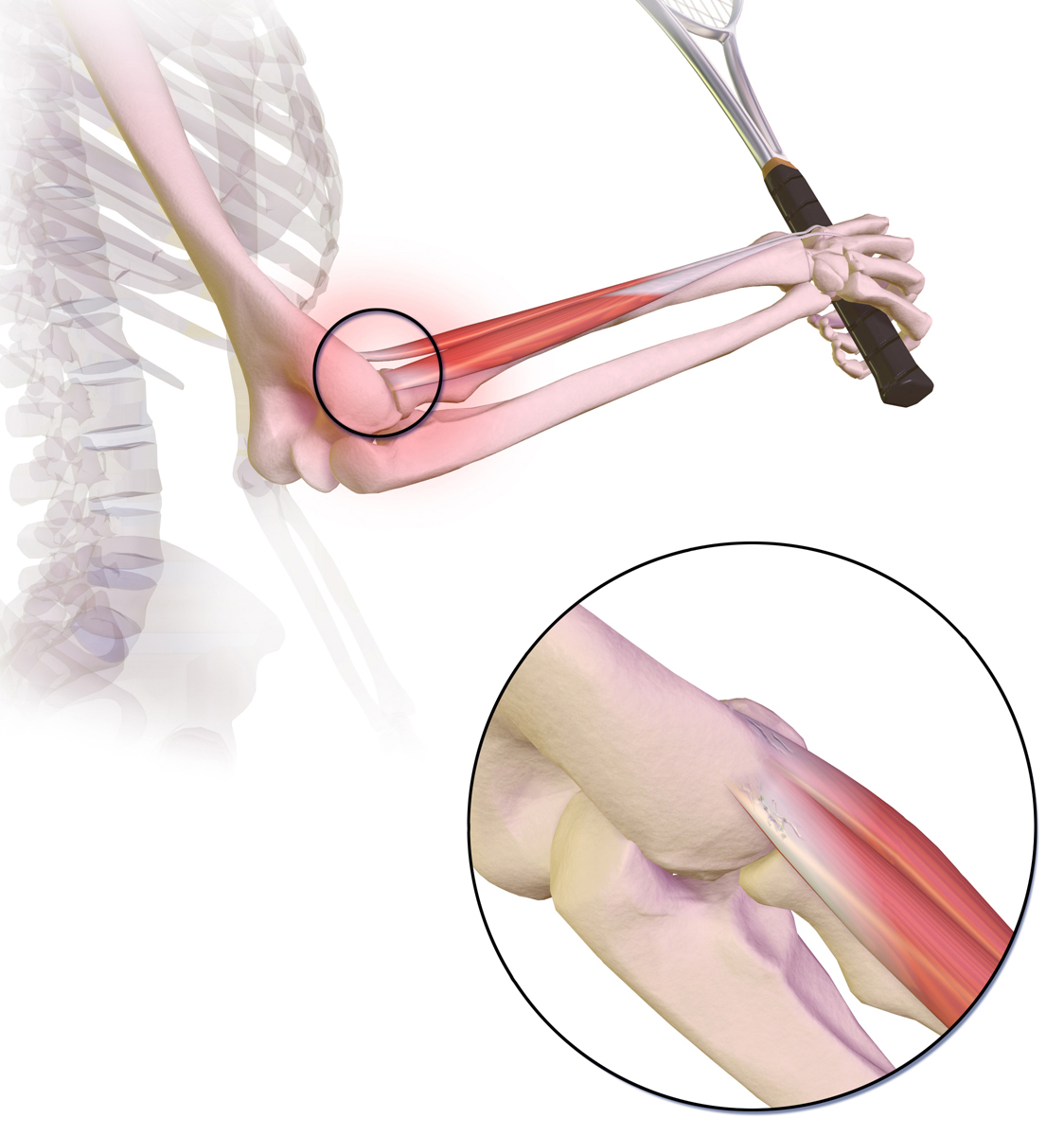 Tennis elbow