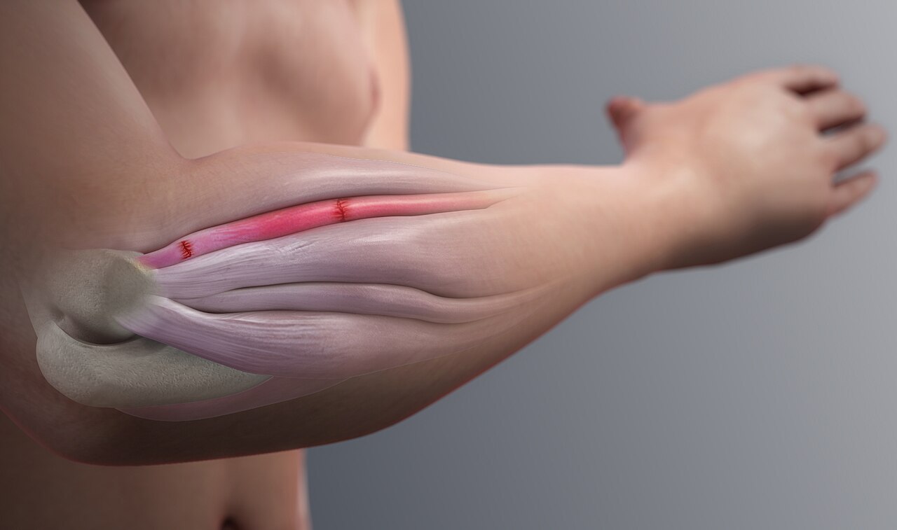Tennis elbow