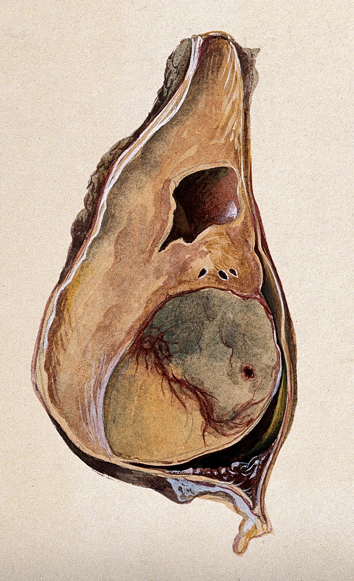Testicular cancer
