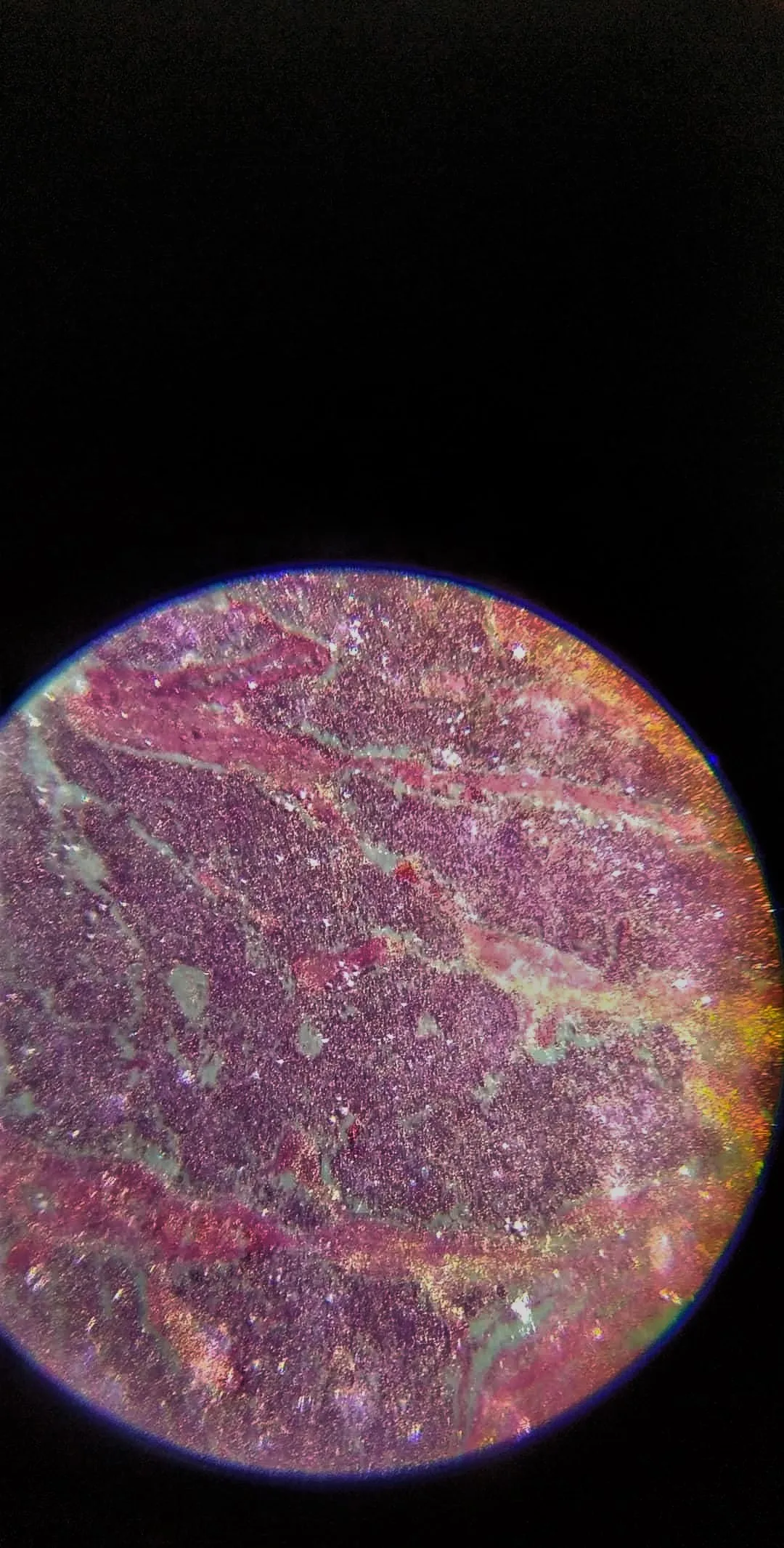 Testicular cancer