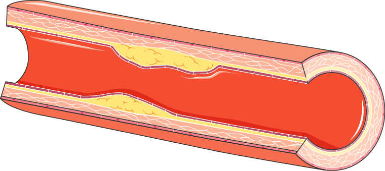 Thrombosis