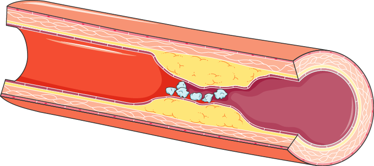 Thrombosis