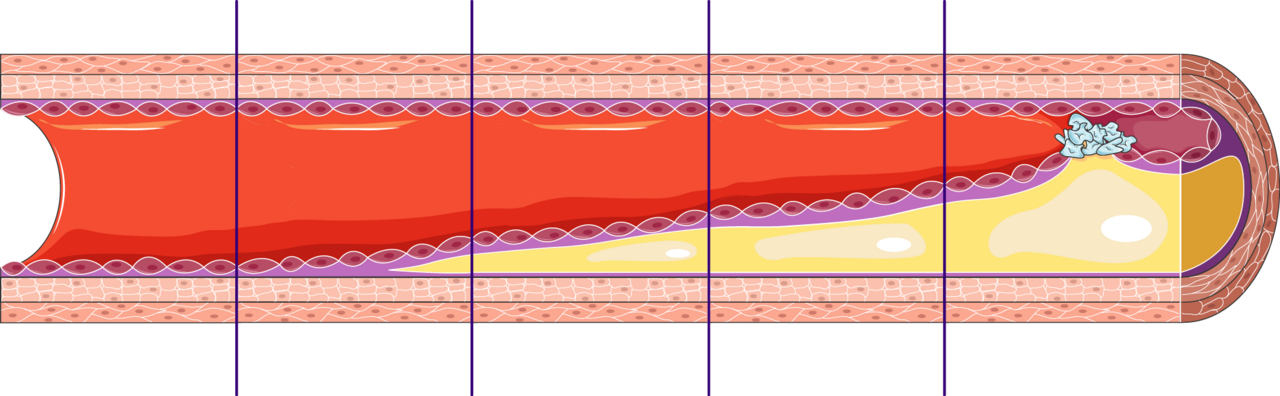 Thrombosis