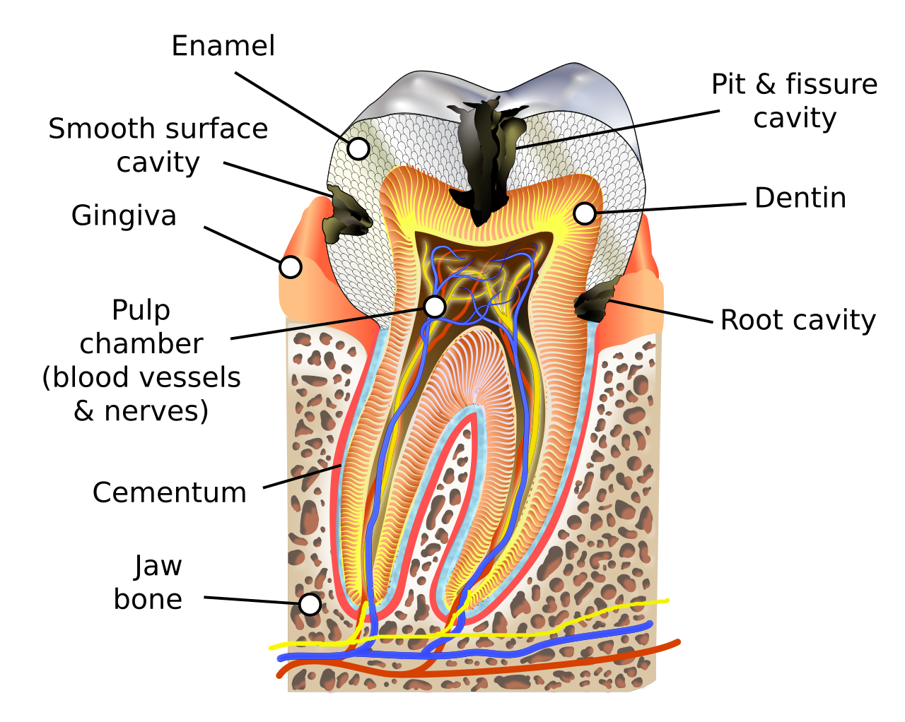 Tooth decay