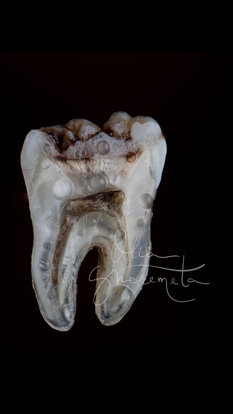 Tooth decay