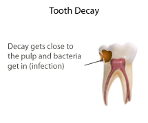Tooth decay