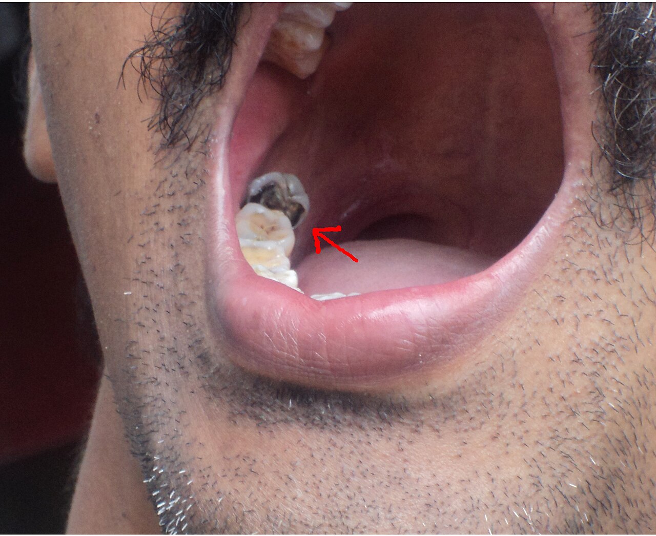 Tooth decay