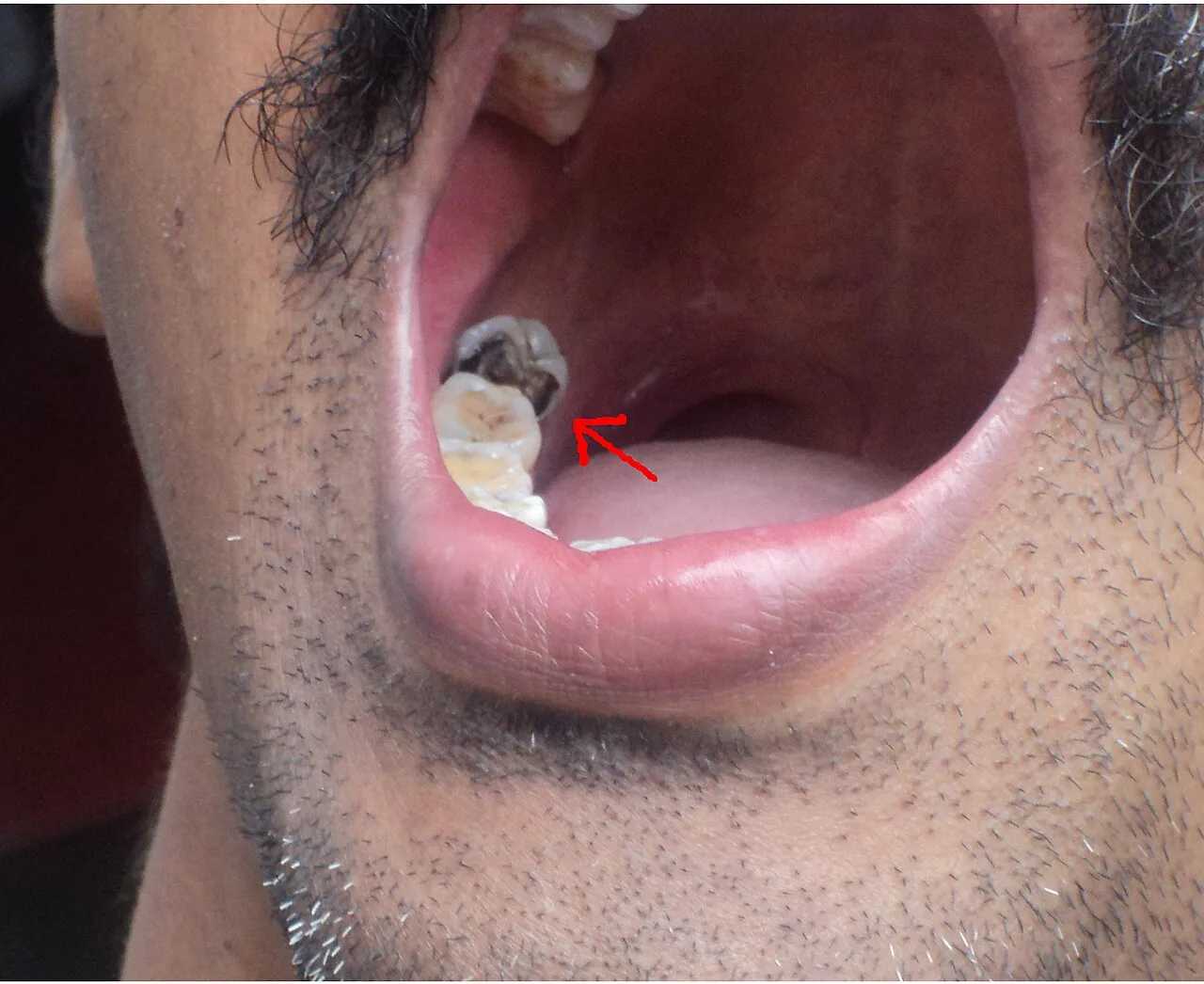 Tooth decay