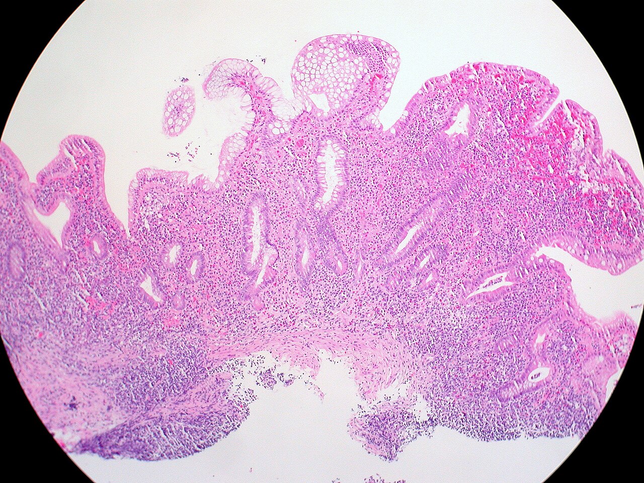 Ulcerative colitis