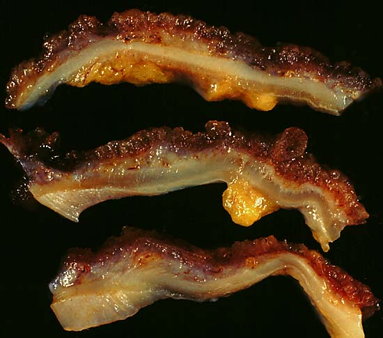 Ulcerative colitis