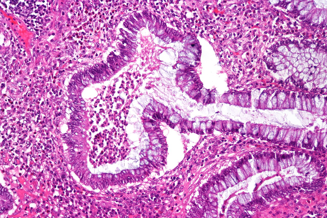 Ulcerative colitis