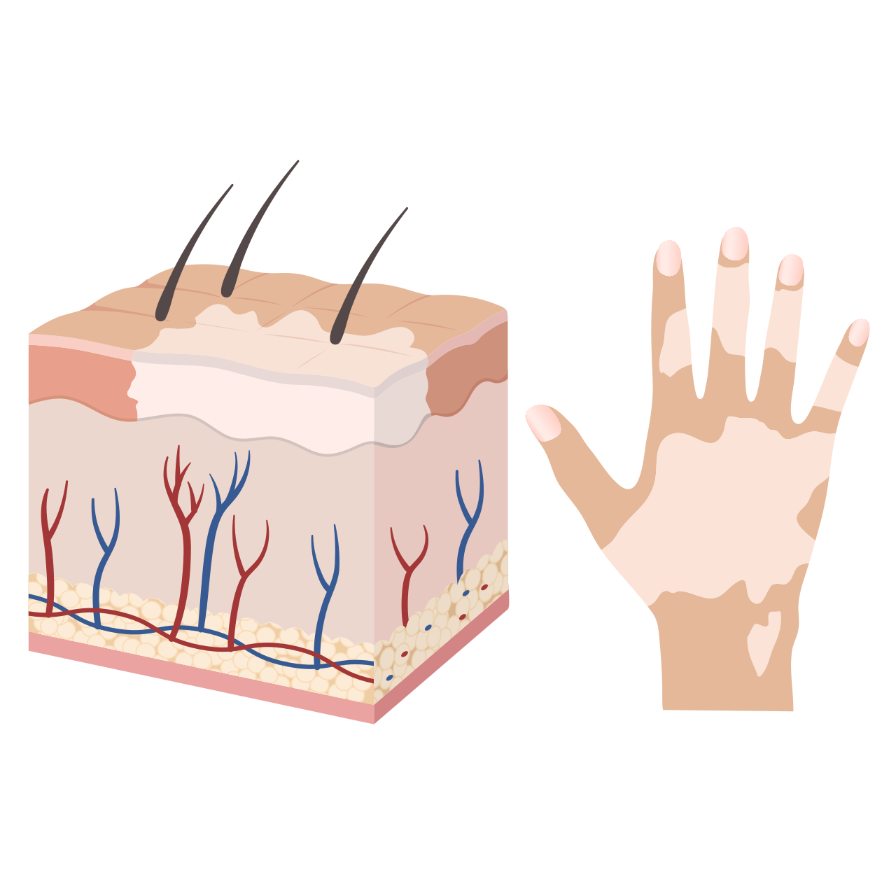 Vitiligo