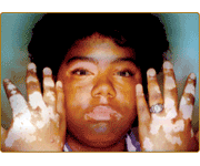 Vitiligo