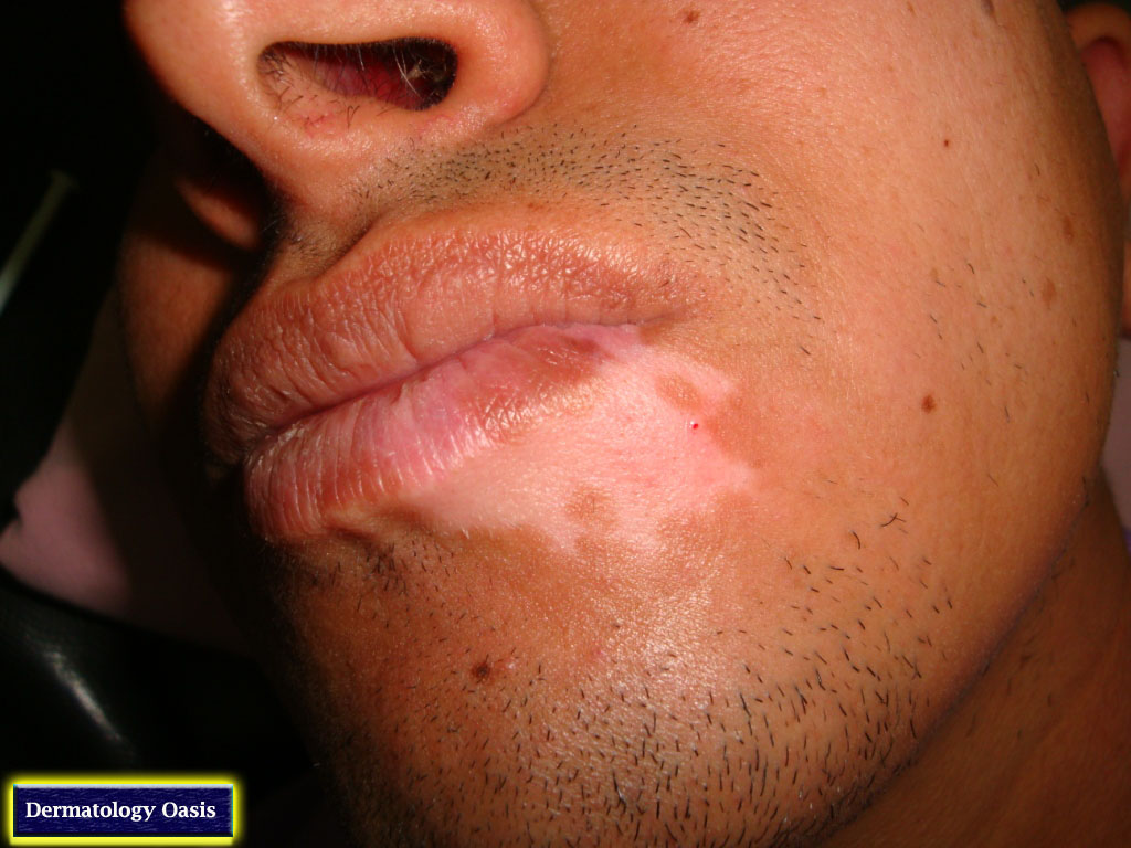 Vitiligo